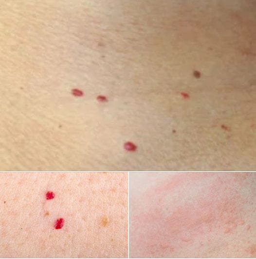 15 objawy Czerwone Kropki na Skórze – Co Oznaczają?