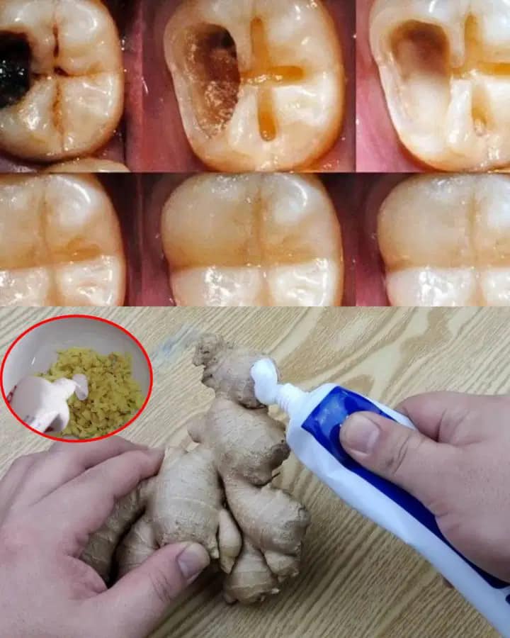(((Jak naturalnie leczyć próchnicę i wzmacniać zęby)))