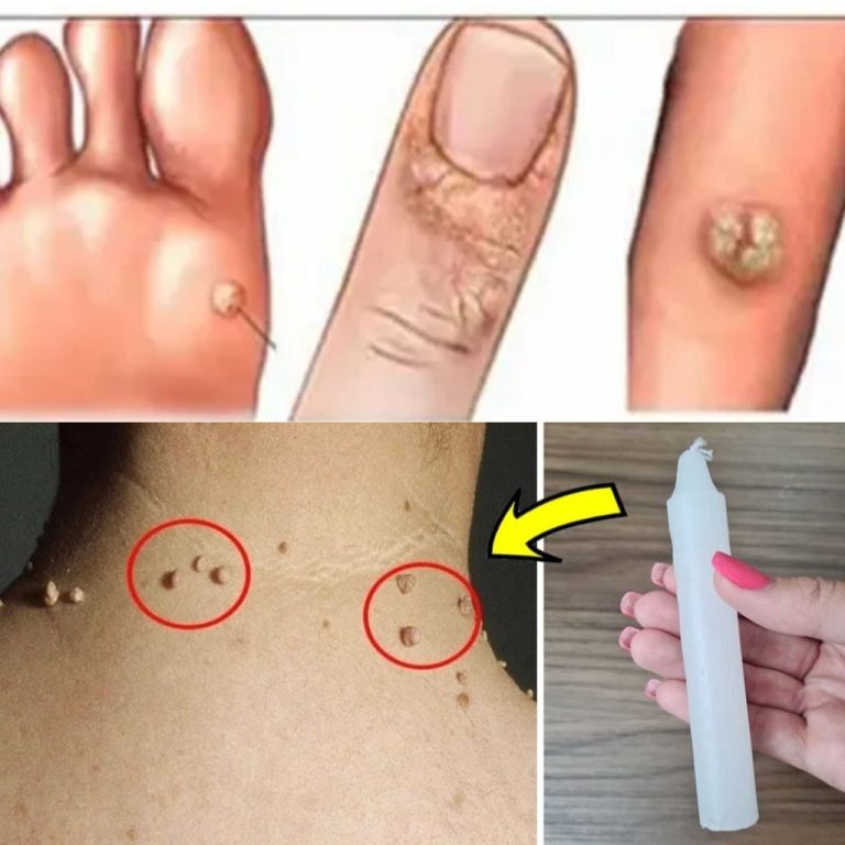 Jak pozbyć się brodawek za pomocą świecy na zawsze