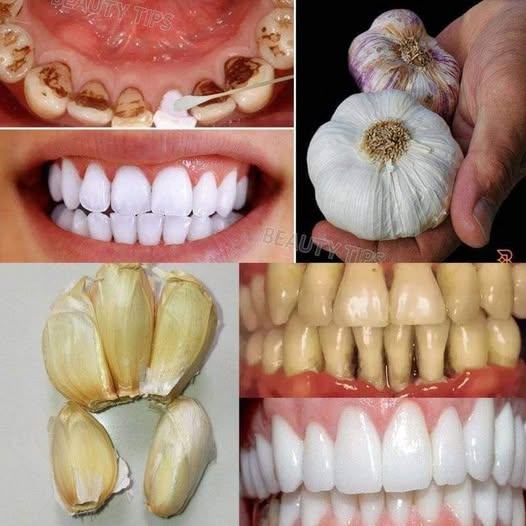 Sekrety, które dentyści chcą przed Tobą ukryć: Czosnkiem możesz usunąć kamień nazębny i wybielić zęby w zaledwie 2 minuty ‎‎