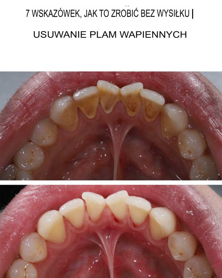 7 świetnych wskazówek, jak usunąć plamy z kamienia nazębnego
