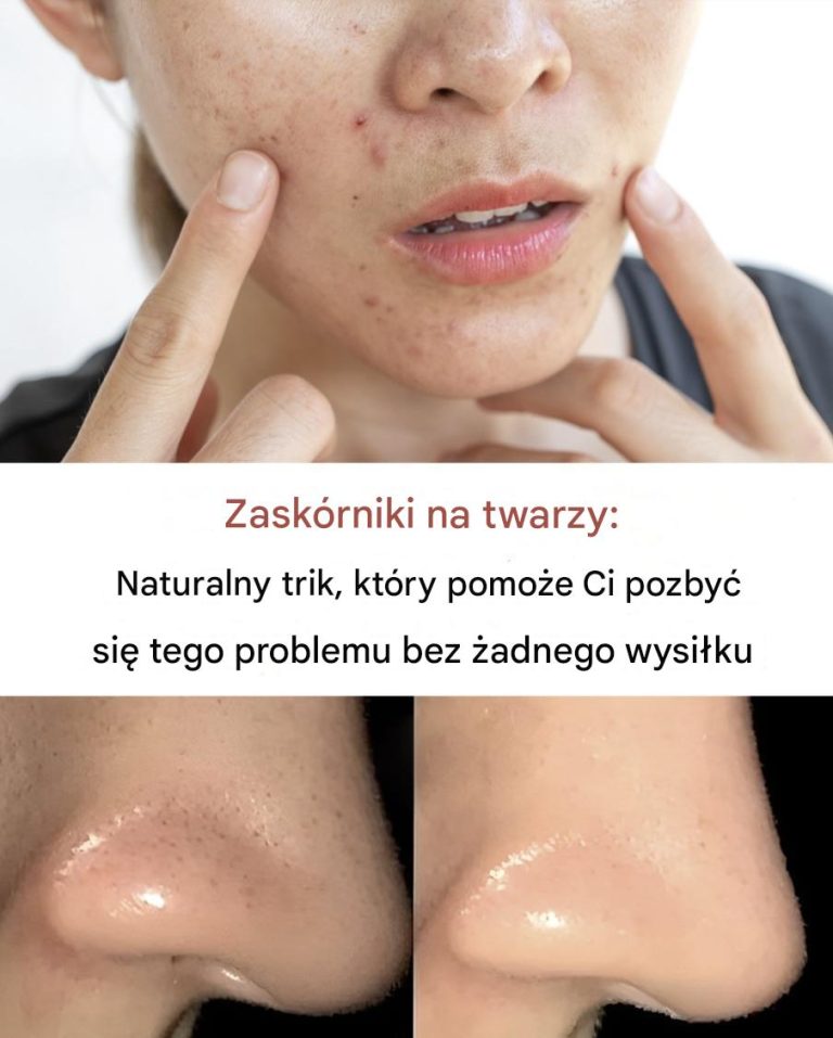 Jak usunąć zaskórniki z twarzy?