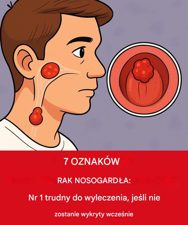 7 objawów raka nosogardła: nr 1 jest trudny do leczenia, jeśli nie zostanie wykryty wcześnie