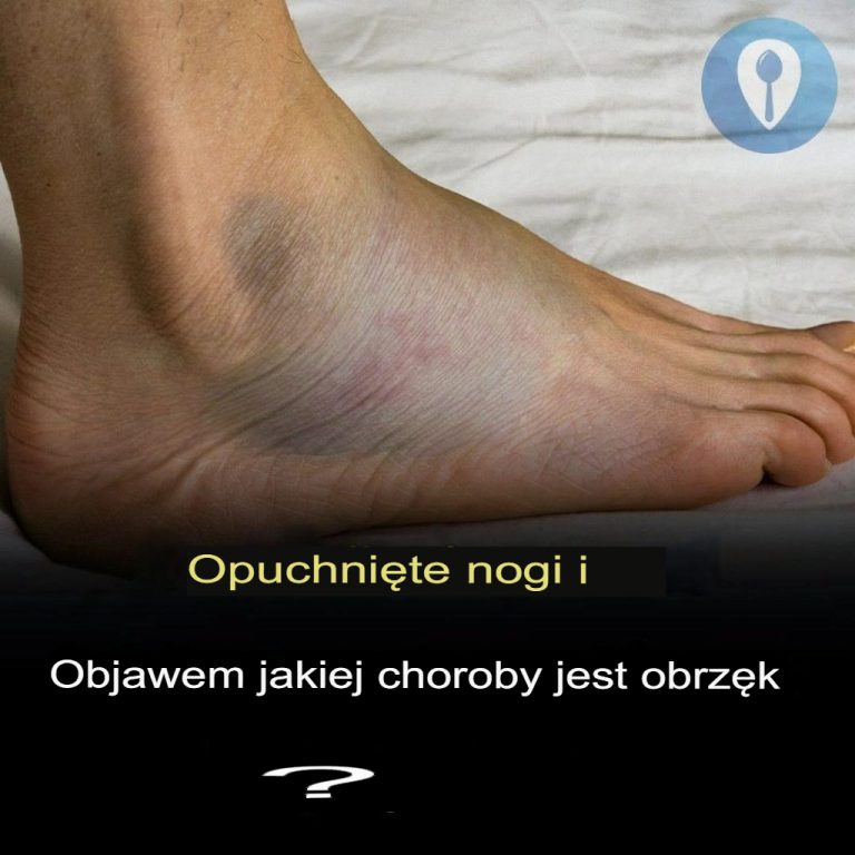 Obrzęk nóg i obrzęk: jakie mogą być przyczyny?