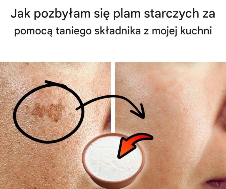 Jak pozbyłam się plam starczych za pomocą taniego składnika z mojej kuchni