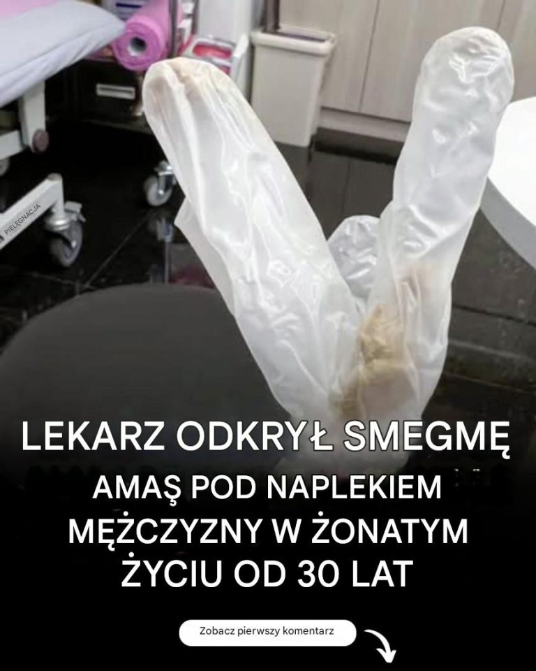 Lekarz odkrył 30-letnie nagromadzenie smegmy pod napletkiem żonatego mężczyzny, który cierpiał z powodu potwornego bólu