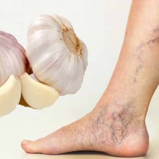 Pożegnaj się z żylakami dzięki tym dwóm naturalnym przepisom