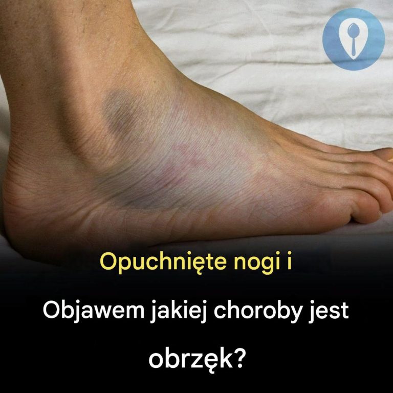 🦵Obrzęk nóg i obrzęk: jakie mogą być przyczyny?