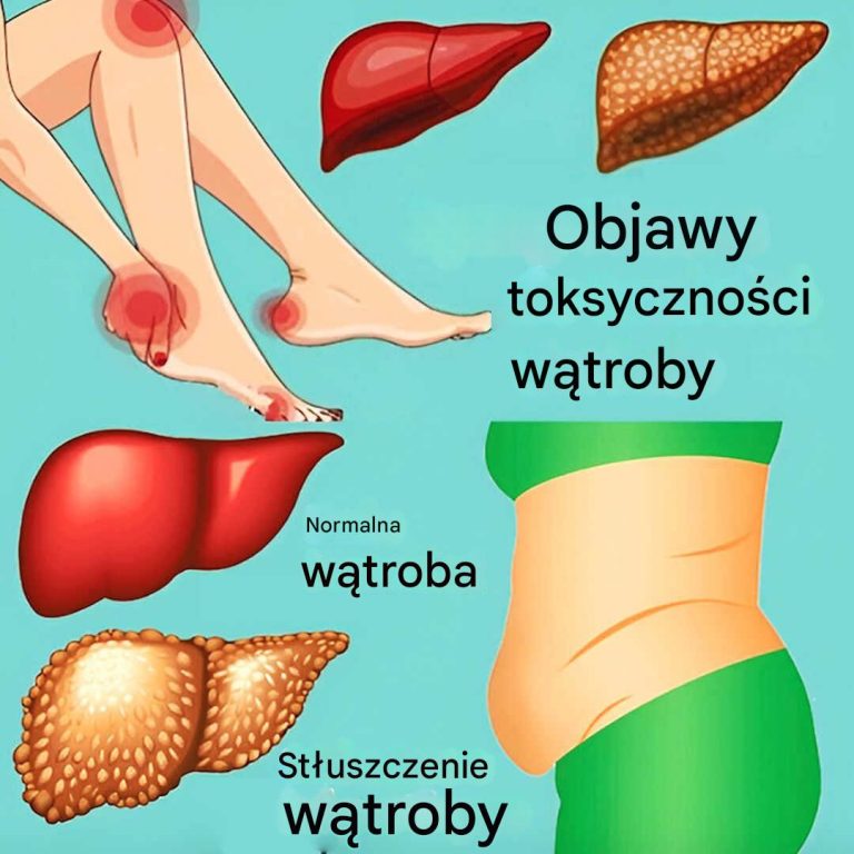 11 oznak dysfunkcji wątroby i gromadzenia się toksyn w organizmieWątroba to jeden z kluczowych organów naszego ciała. To prawdziwy, naturalny filtr, który usuwa toksyny i pełni wiele ważnych funkcji.