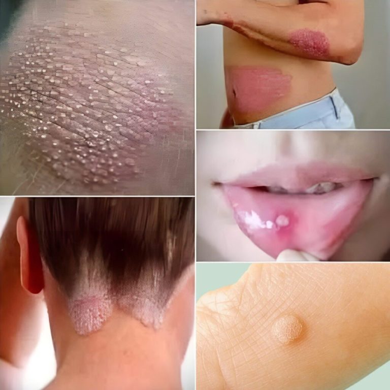 Objawy wirusa brodawczaka ludzkiego (HPV), które musisz znać