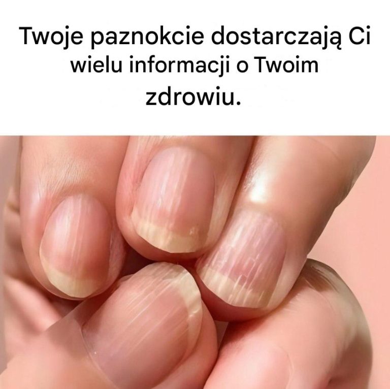 Co Twoje paznokcie mówią o Twoim zdrowiu