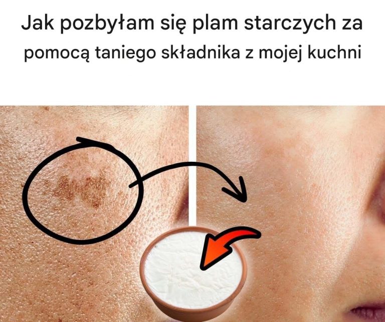 Jak pozbyłam się plam starczych za pomocą taniego składnika z mojej kuchni
