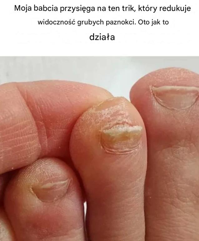 Nieoczekiwanie, problemy z paznokciami u stóp mogą pojawić się u osób w każdym wieku.