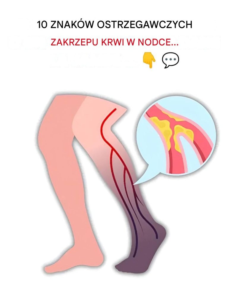 10 najczęstszych objawów zakrzepu krwi w nodze (zapobieganie zakrzepicy żył głębokich)