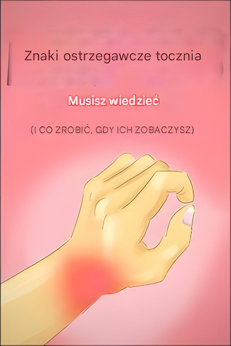 Rozpoznawanie zagrożeń zdrowotnych: 8 objawów tocznia