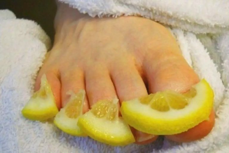 Wyeliminuj grzybicę paznokci: Skutecznie lecz grzybicę paznokci w 100% naturalną cytryną i solą