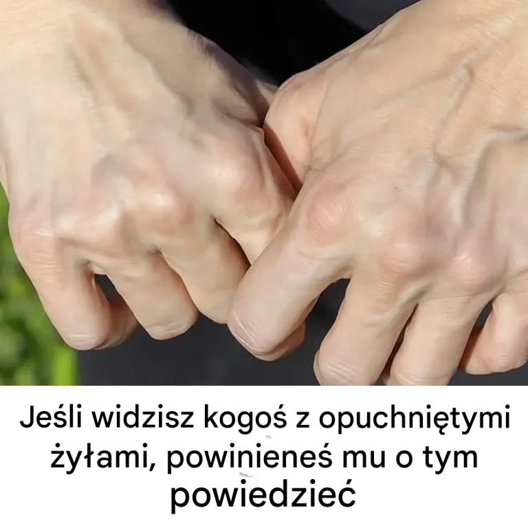 Znaczenie i wskazówki dotyczące leczenia obrzękniętych żył